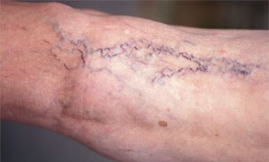 bacaklardaki varisli damarları tedavi etme yöntemleri