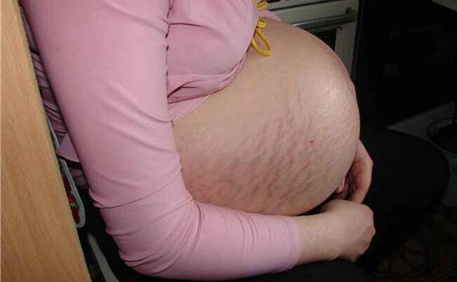 Hamilelik sırasında varisli damarların nedenleri