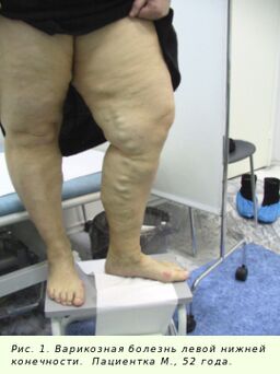 Süreci durdurmak için varisli damarlar tedavi edilmelidir