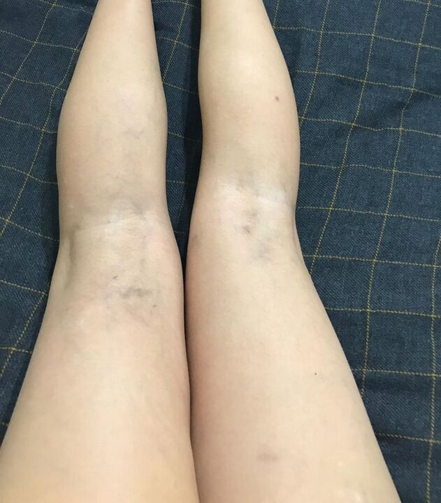 bacaklarda varisli damarların belirtileri